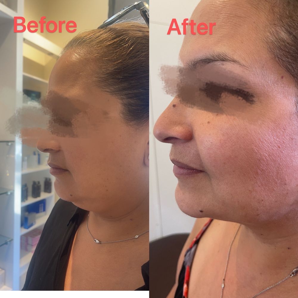 Before and after facial rejuvenation
