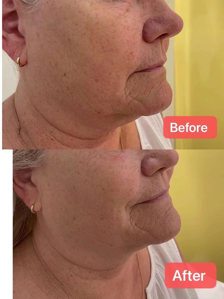 Before and after facial treatment